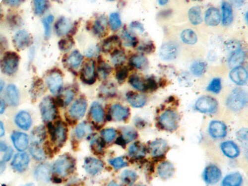 IHC of TRAcP on an FFPE Hairy Cell Leukemia Tissue